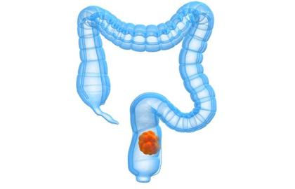 瘫痪老人长期便秘的危害,长期喝酒便秘有什么危害