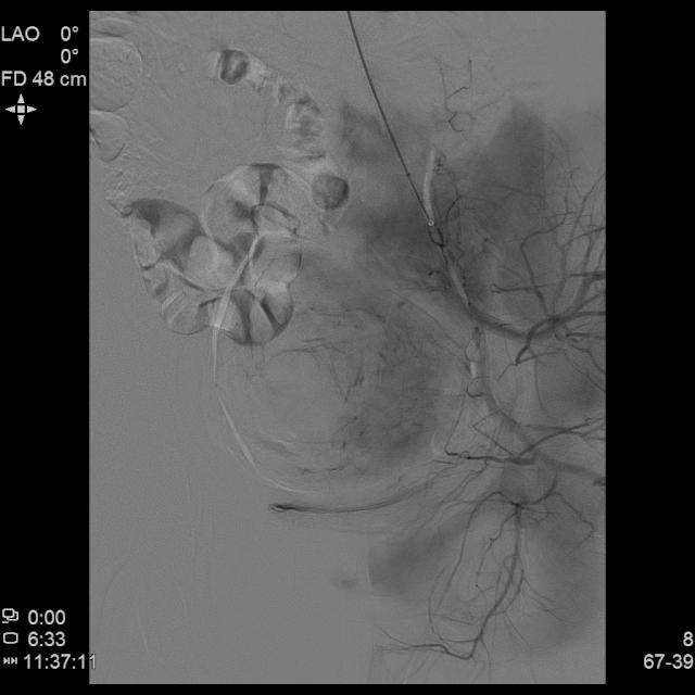 子宫腺肌病保守治疗无效怎么办?