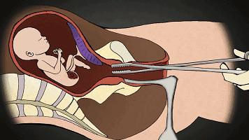 人流最多次案例,20岁女孩人流七次后续