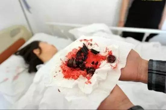 升降椅自爆女子被“*菊爆**”肠道取出多枚碎片！警惕屁股下的椅子