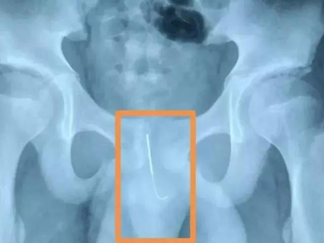 熊孩子用弹弓射人被垃圾车送走,9岁男孩把飞镖塞下来