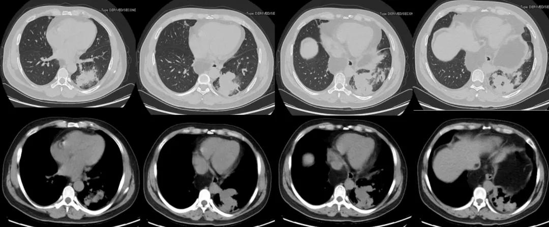 咳嗽10多天了有白痰细菌感染,咳嗽是肺部真菌感染吗