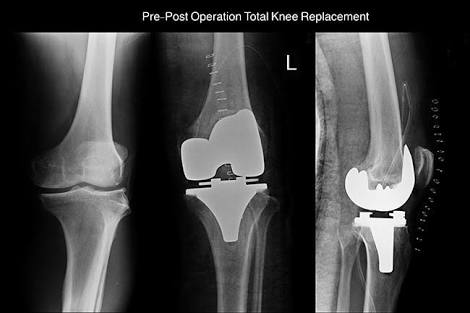 关节炎可以通过打抗生素治疗吗,关节炎治疗的注意事项
