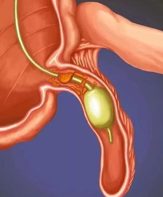 怎么让阑尾炎不复发,不开刀也能治愈阑尾炎