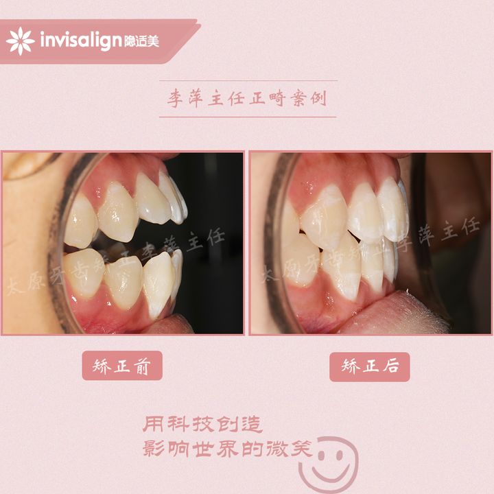 太原矫正牙齿需要做正颌吗,太原牙齿二次矫正