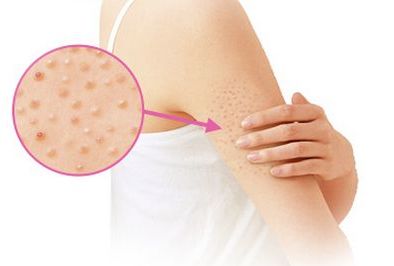 夏天手上长痘痒是怎么回事,夏天手上起小水泡发痒怎么回事