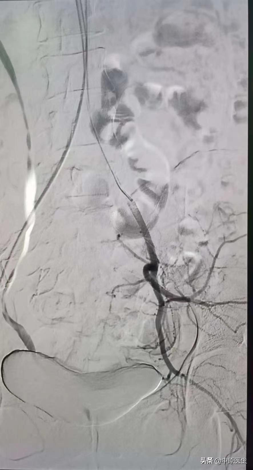 如果自己强烈要求剖宫产可以吗,专家提醒不能生育