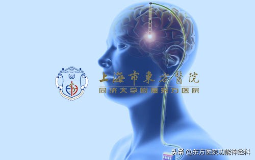 dbs治疗帕金森术后用不用吃药,dbs手术延缓帕金森痴呆