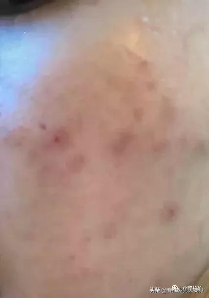 祛痘印最好的方法目前最有效的,祛痘印有效的精华