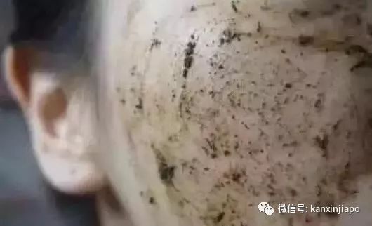 额头长闭口毛孔粗大爆痘怎么办,皮肤爆痘起闭口怎么回事