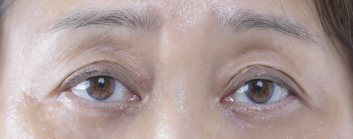 三角眼单眼皮怎么改善,三眼皮怎么改善成双眼皮