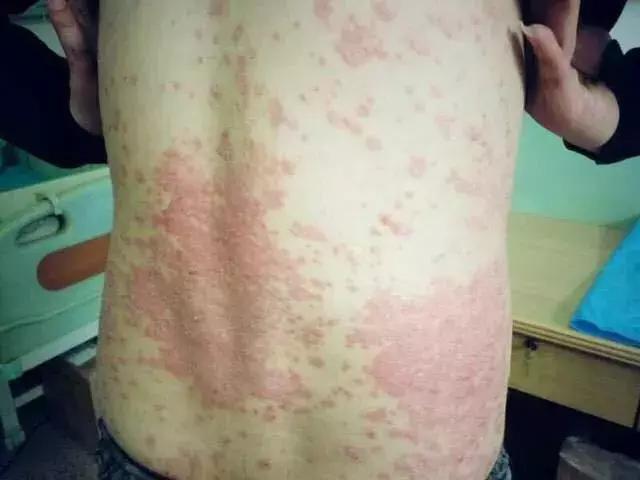 银屑病6大诱因自测表,银屑病机理研究