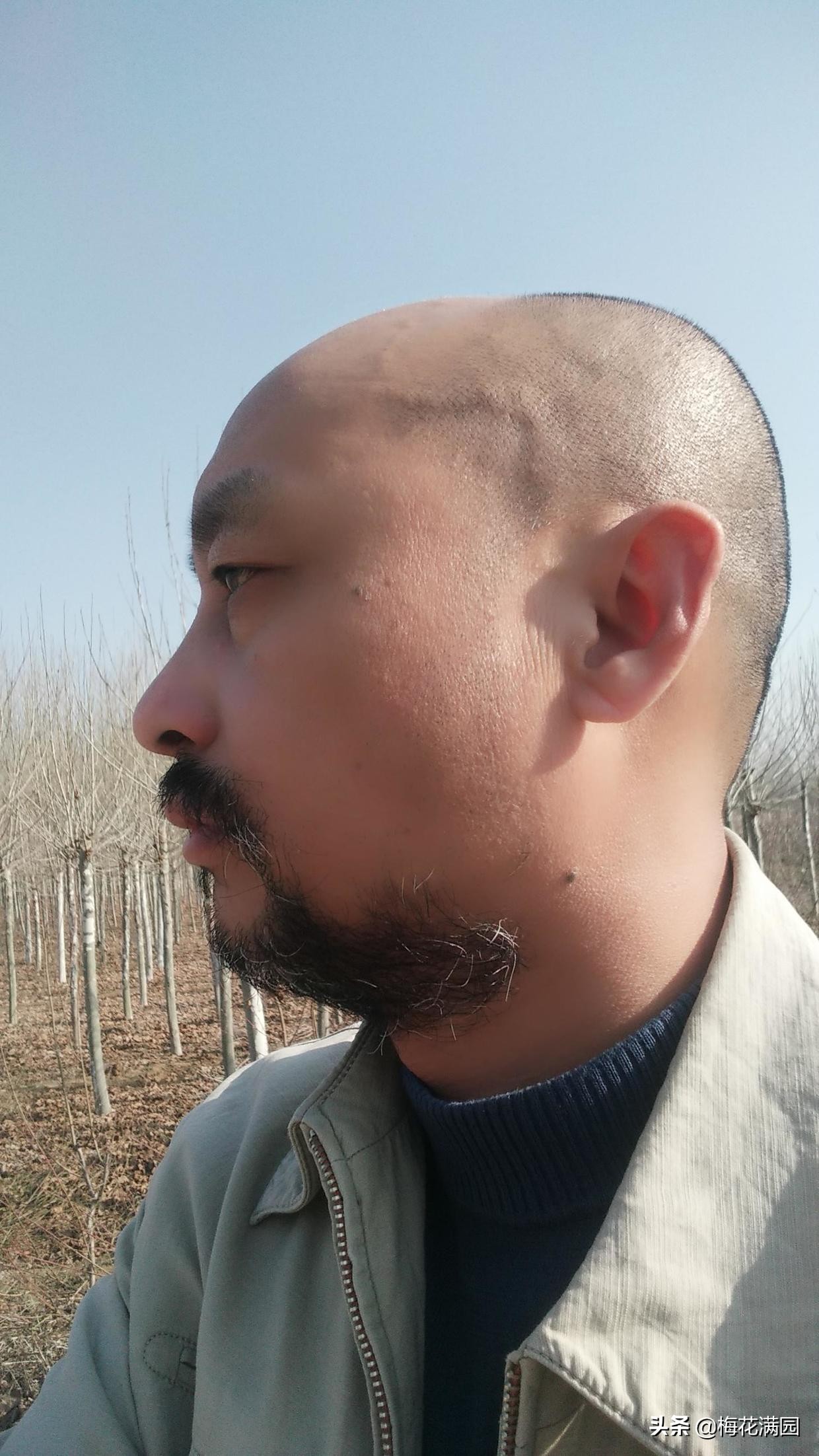 脱发的故事：那位大夫说得可真准啊