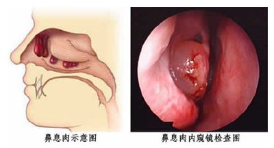 息肉是癌细胞还是痔疮,息肉是肿瘤的一种吗