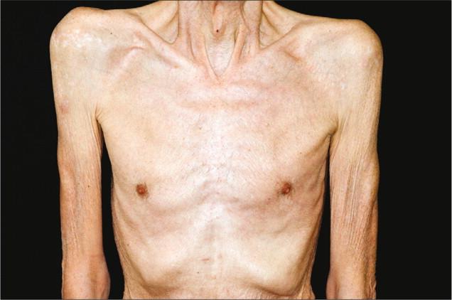 肿瘤晚期瘦到皮包骨,肿瘤治疗后身体消瘦怎么办