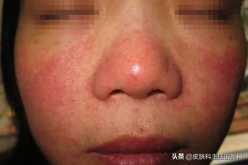 脸上痘印变成癣了怎么回事,痘印长癣