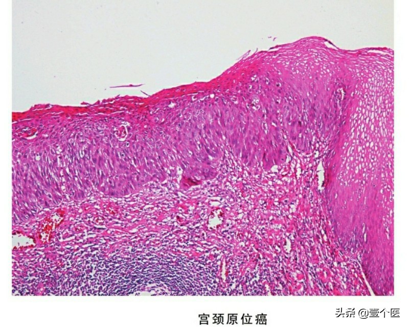 病理单上的癌前病变、非典型性增生及原位癌还是傻傻分不清？