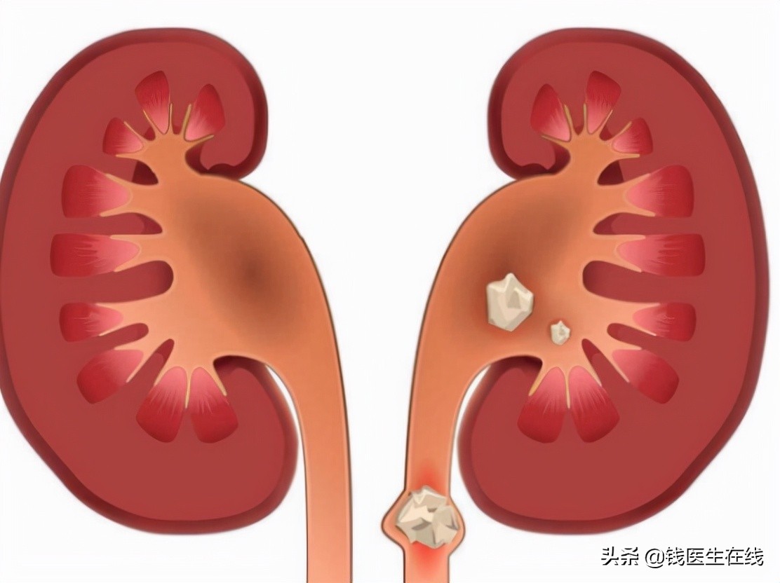 肾结石怎么才能消净,肾结石如何彻底解决问题