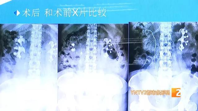 双肾多发结石取出2000多颗,史上最大手术取出肾结石