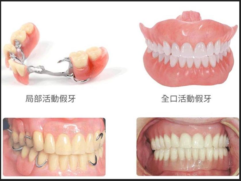 老人戴假牙多长时间换一次,老人戴的假牙可以用多久