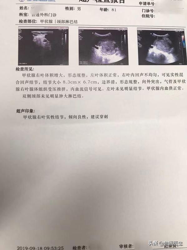 8旬老人甲状腺癌挤压气管向左侧移位术前评估中