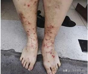 猫狗身上跳蚤多掉毛怎么办,猫狗身上有虱子跳蚤怎么办