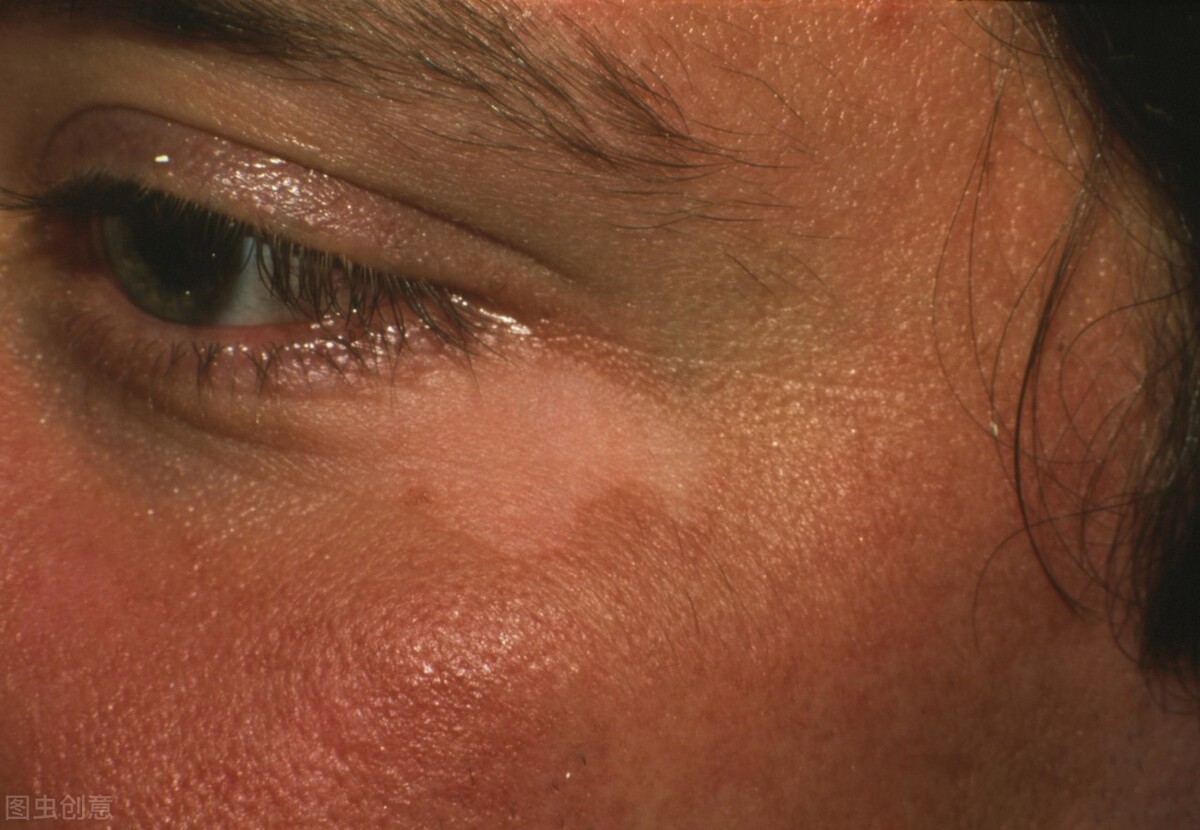 白癜风不治疗可以吗,白癜风不治疗会严重吗