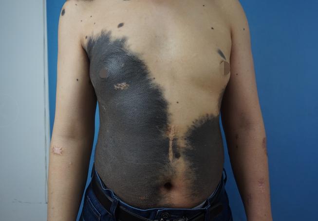 色素痣和黑毛痣的区别,黑毛痣是什么东西