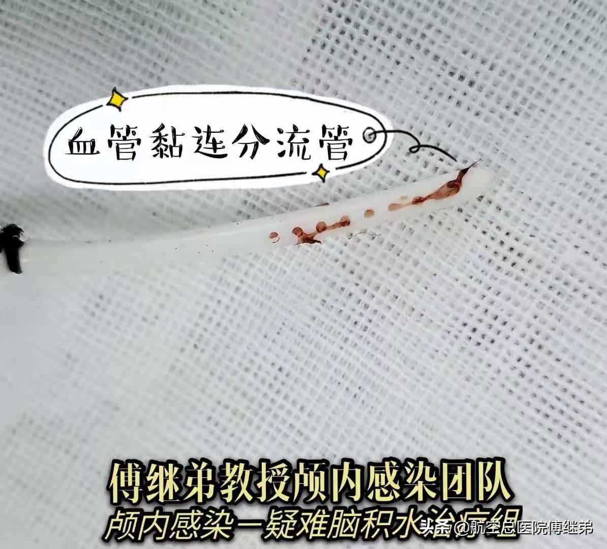 鲍曼不动杆菌多重耐药血液感染,鲍曼不动杆菌感染死亡率