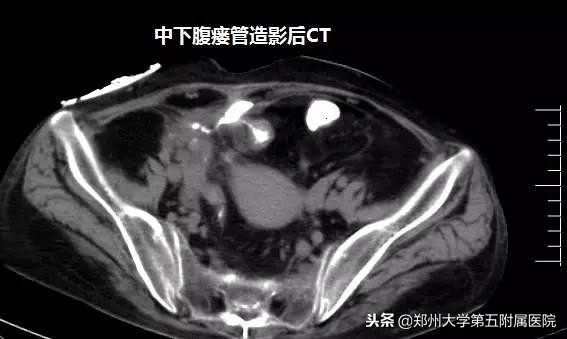 十来年肠绞痛的表现和处理方法,十年腹痛