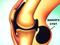 关于治疗类风湿关节炎的讲座视频,如何用药可以延缓类风湿关节炎