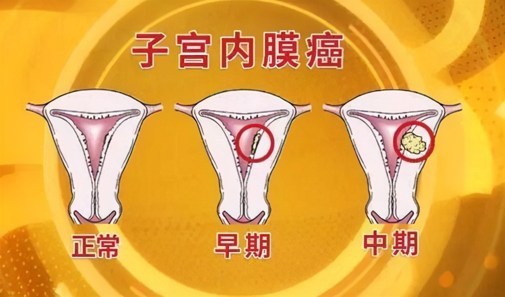 绝经后出血警惕四种疾病,绝经后出血当心卵巢癌