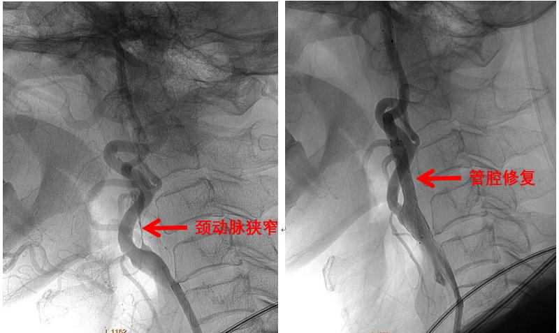 介入不放支架可以吗,介入放支架治标不治本