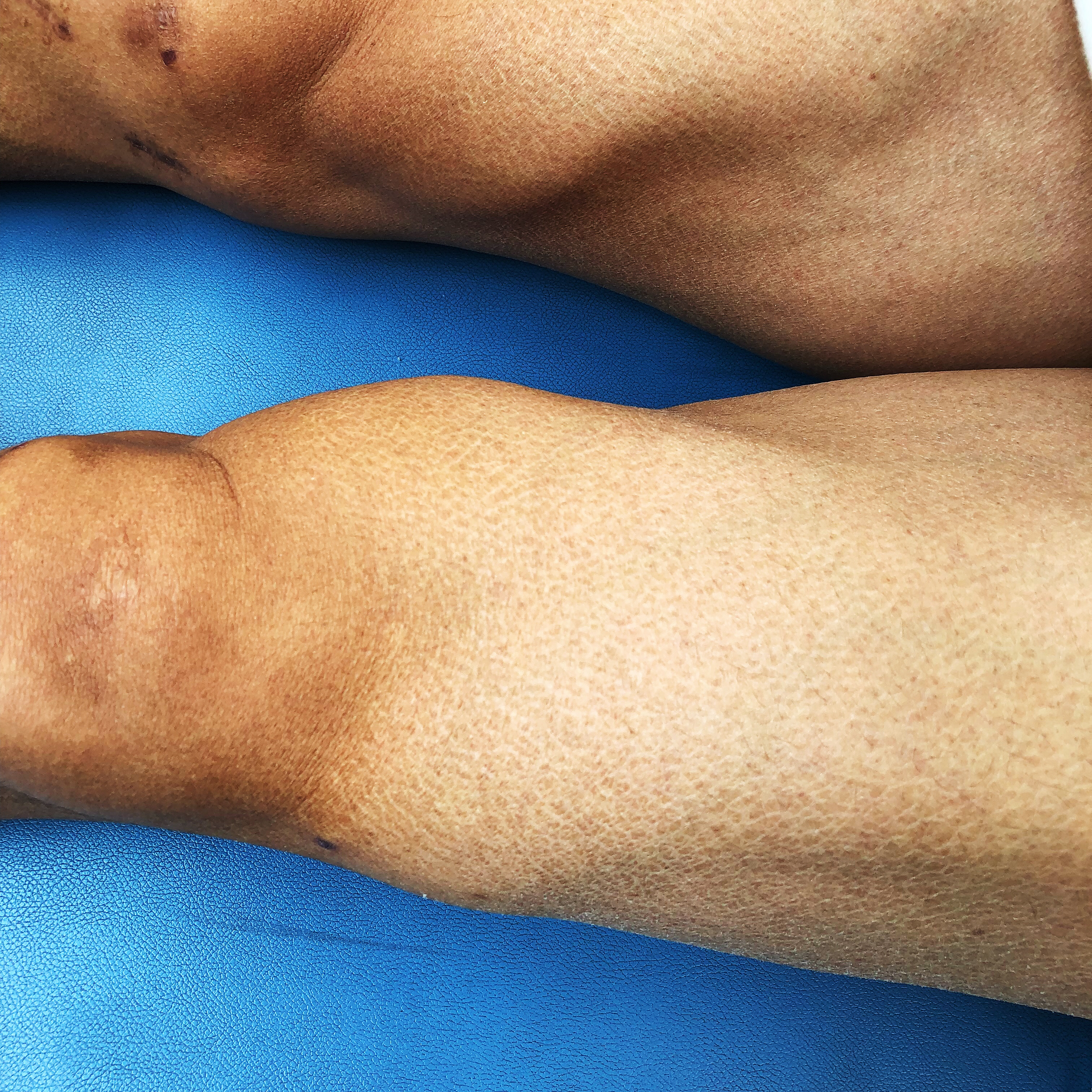 康复训练直抬腿的正确训练方法,直腿康复训练