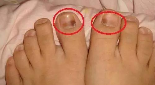 跑步跑出黑指甲怎么处理,跑步后脚趾甲充血变黑怎么办