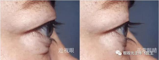 眼镜戴久了眼睛会变形变凸吗,经常戴近视眼镜眼睛会凸吗