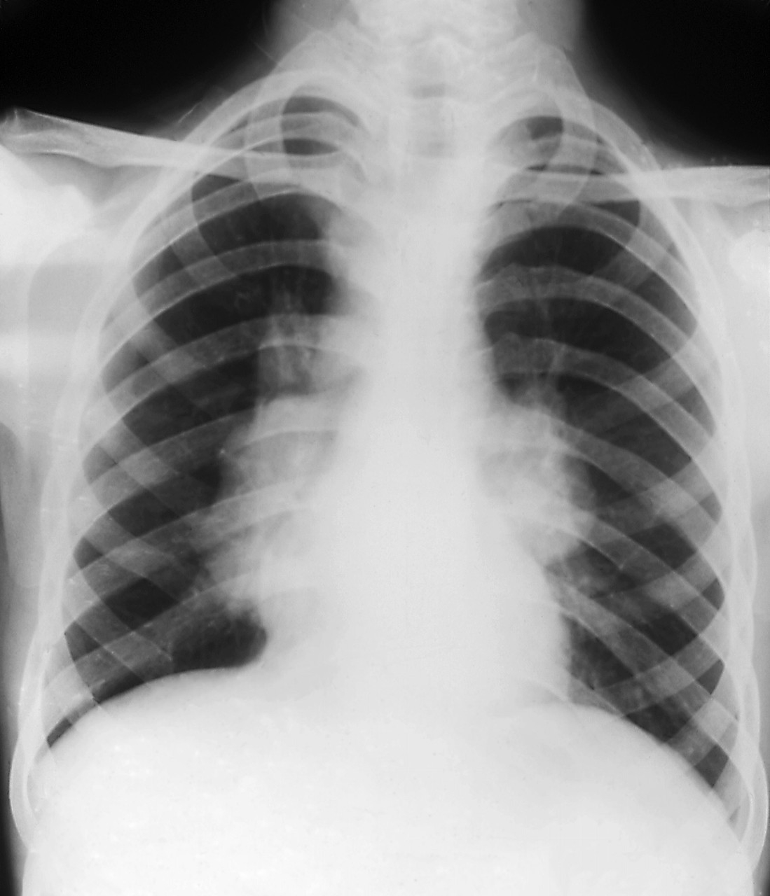 肺结节伴有胸痛是良性还是恶性,肺结节可能引起胸疼吗