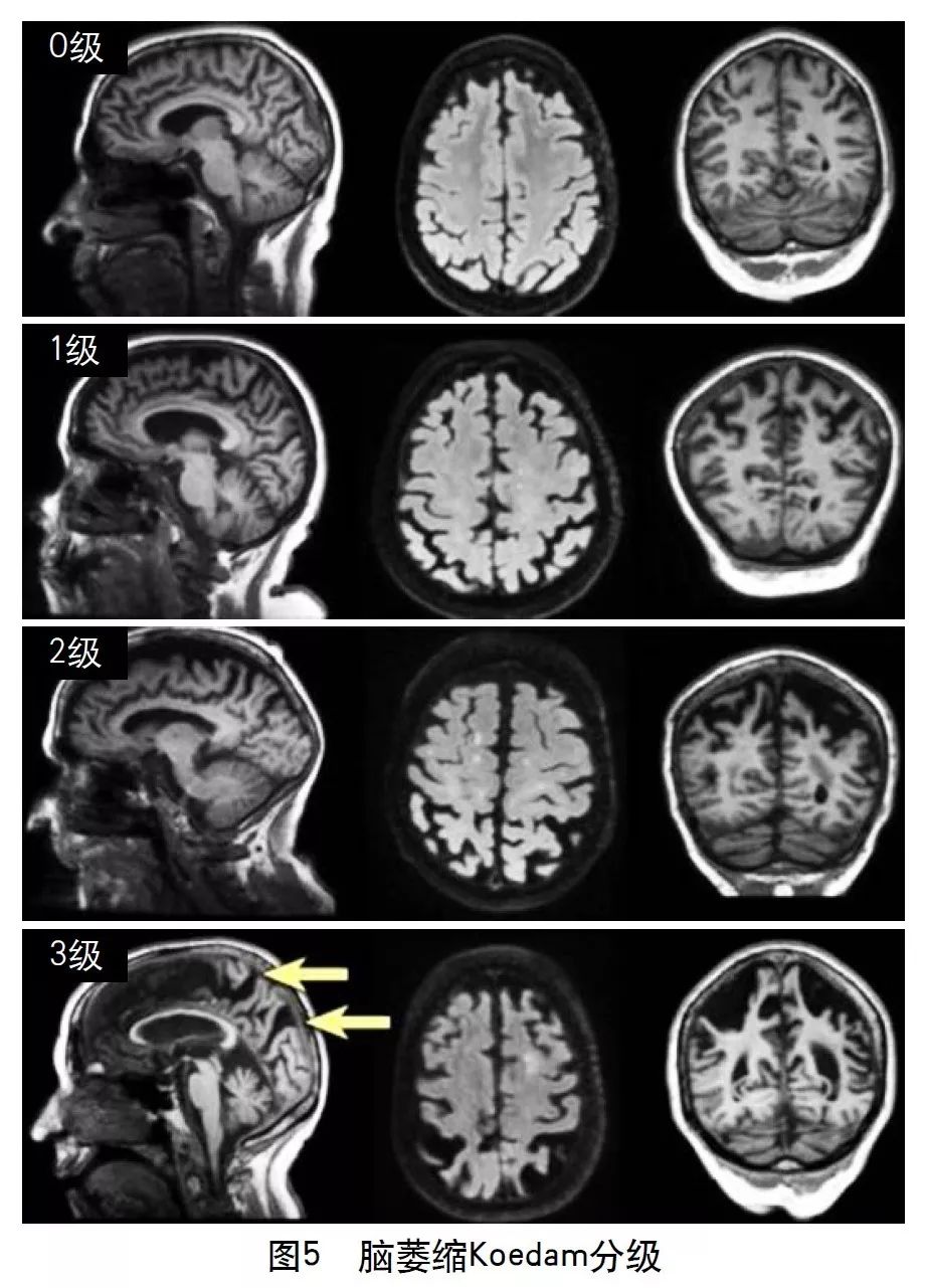 脑血管病影像诊断大全汇总,脑小血管病变影像学表现