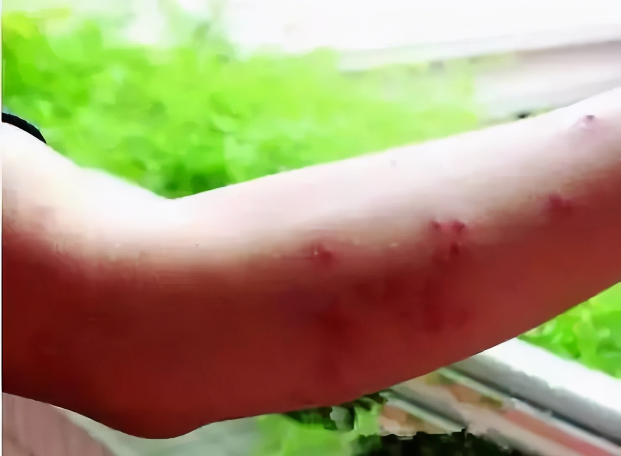 孩子被咬后,若呈现这些状况代表不是蚊子咬的包,别自行处理