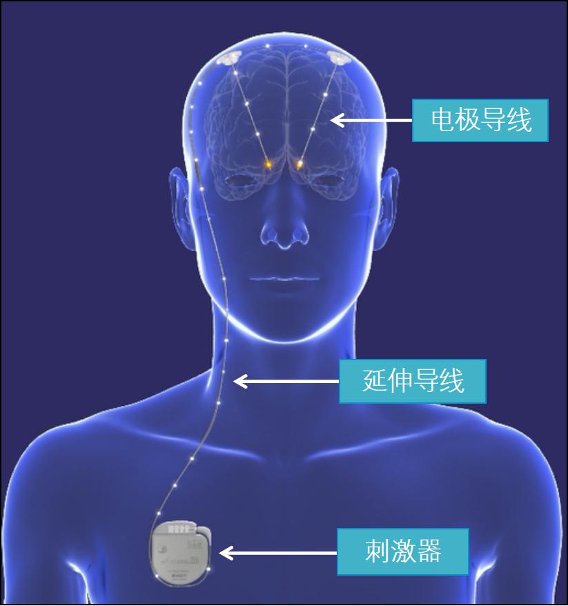 脑起搏器dbs是什么意思,dbs脑起搏器哪里做最好