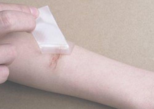 烧伤疤痕后遗症怎么治,烧伤愈合后疤痕处理案例