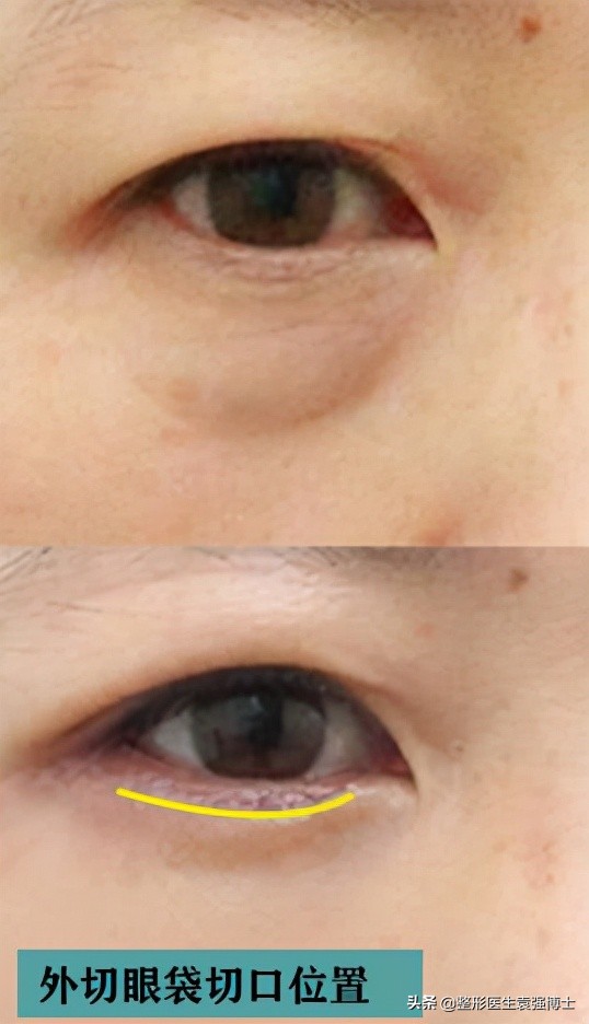 最简单最有效的祛眼袋方法,做了眼袋后悔