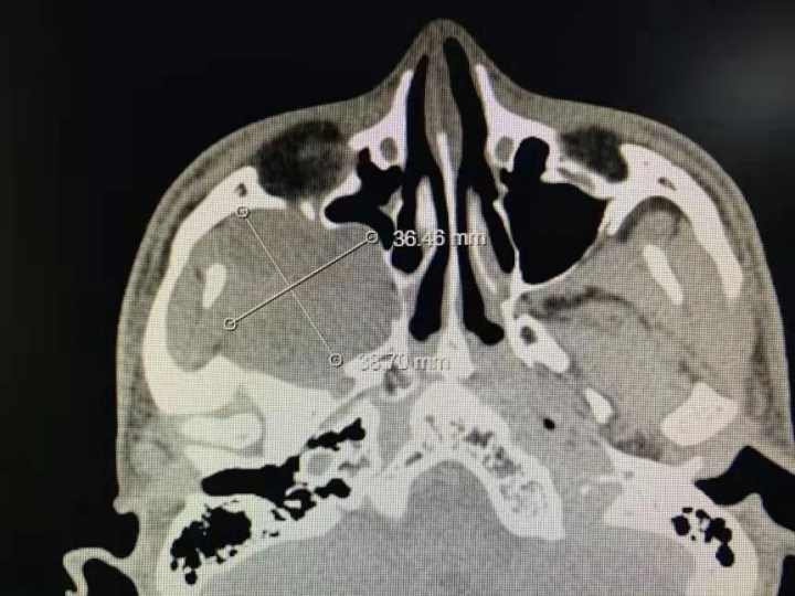 寤跺ぇ闄勫睘鍖婚櫌鑲跨槫,棰岄潰娣遍儴鑲跨槫鎬庝箞娌荤枟