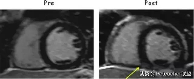 运动员心脏：120年的争议与发展