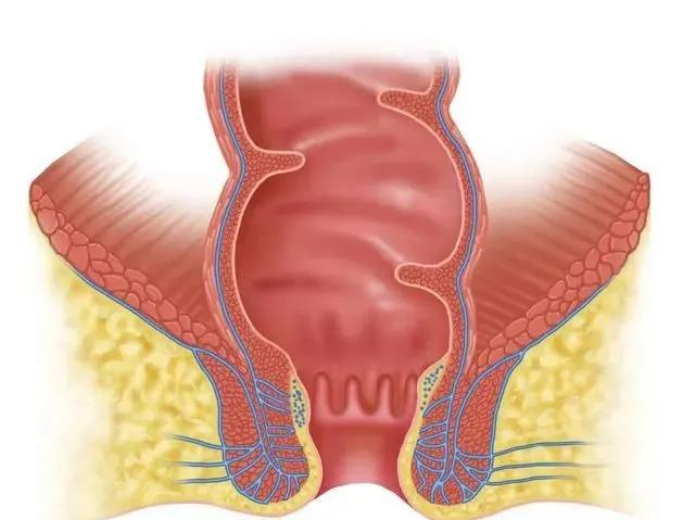 出现肛瘘,高位肛瘘手术造成肛瘘的几率大吗