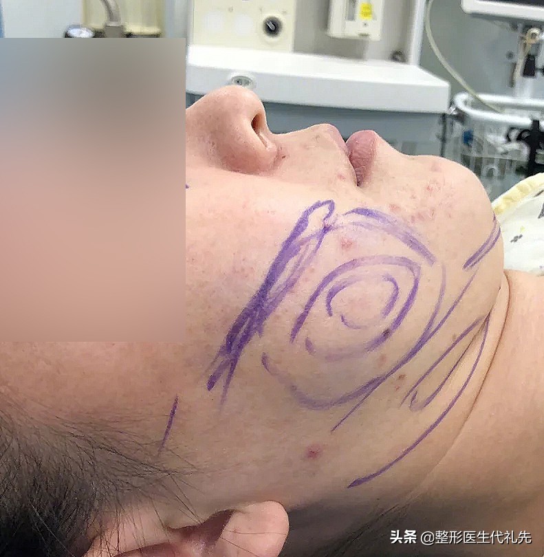 面部吸脂后会长痘痘吗,面部吸脂后皮下会长瘢痕吗