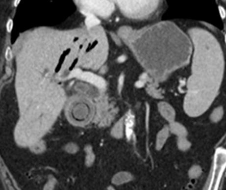 腹部ct能看出来胃的毛病吗,如果胃有问题腹部ct看得出来吗