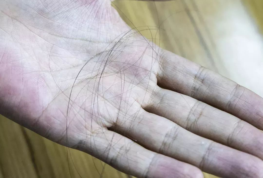 “十男八秃”的日本男人疯抢这瓶小黑钻!让头发不再掉了