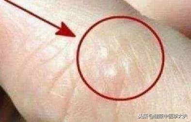 手脚一抓就长许多小水泡中医辨证,小孩手脚身上长水泡还痒怎么办