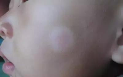 宝宝脸上有虫图解,小孩眼里有虫斑怎么看